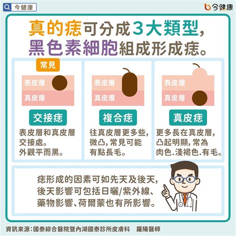 突出來的痣|痣是什麼？一次了解痣原因、就醫時機以及如何改善